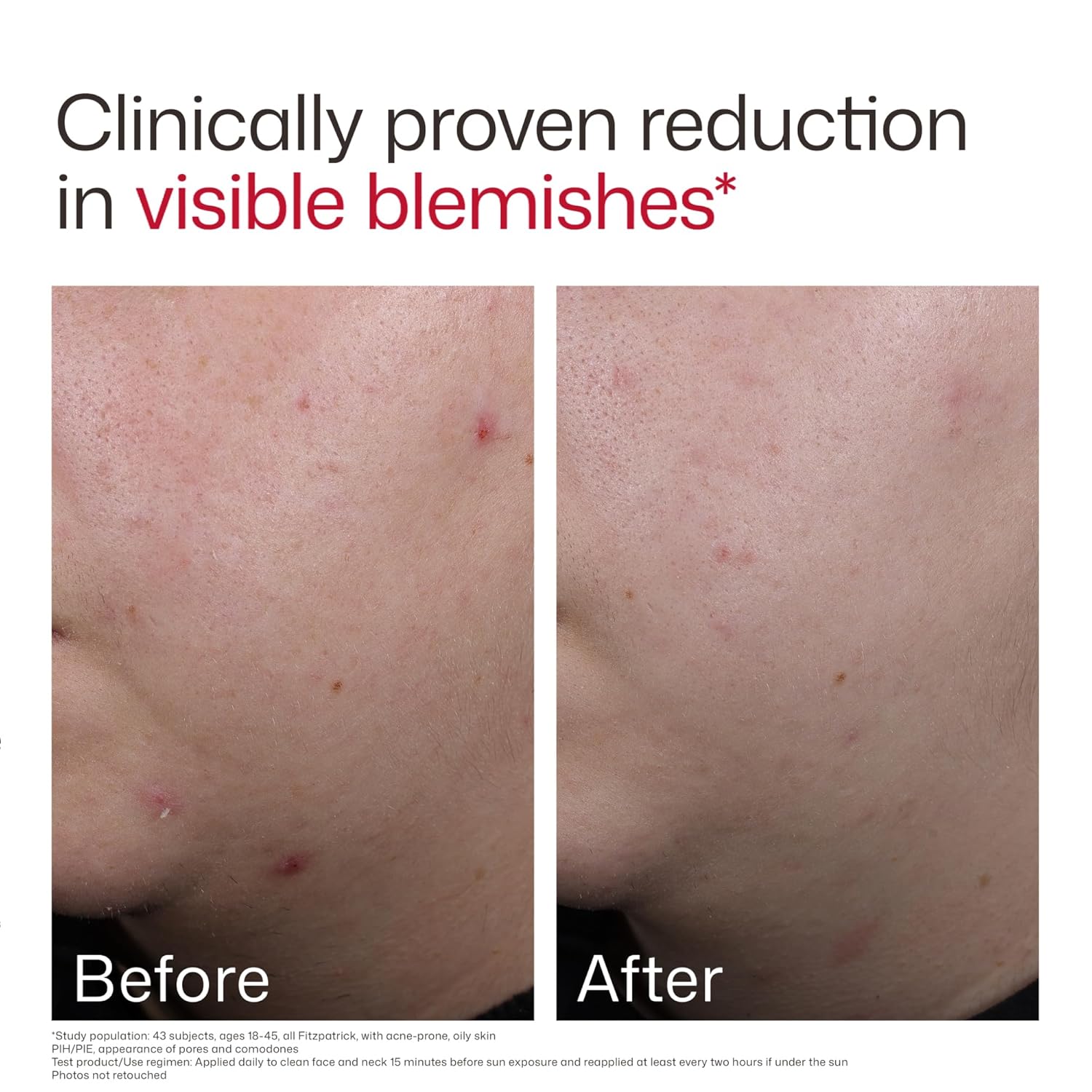 UV Clear Blemish Prone & Oil Balancing