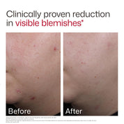 UV Clear Blemish Prone & Oil Balancing