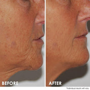 Neck Firming Lift Professional Strength