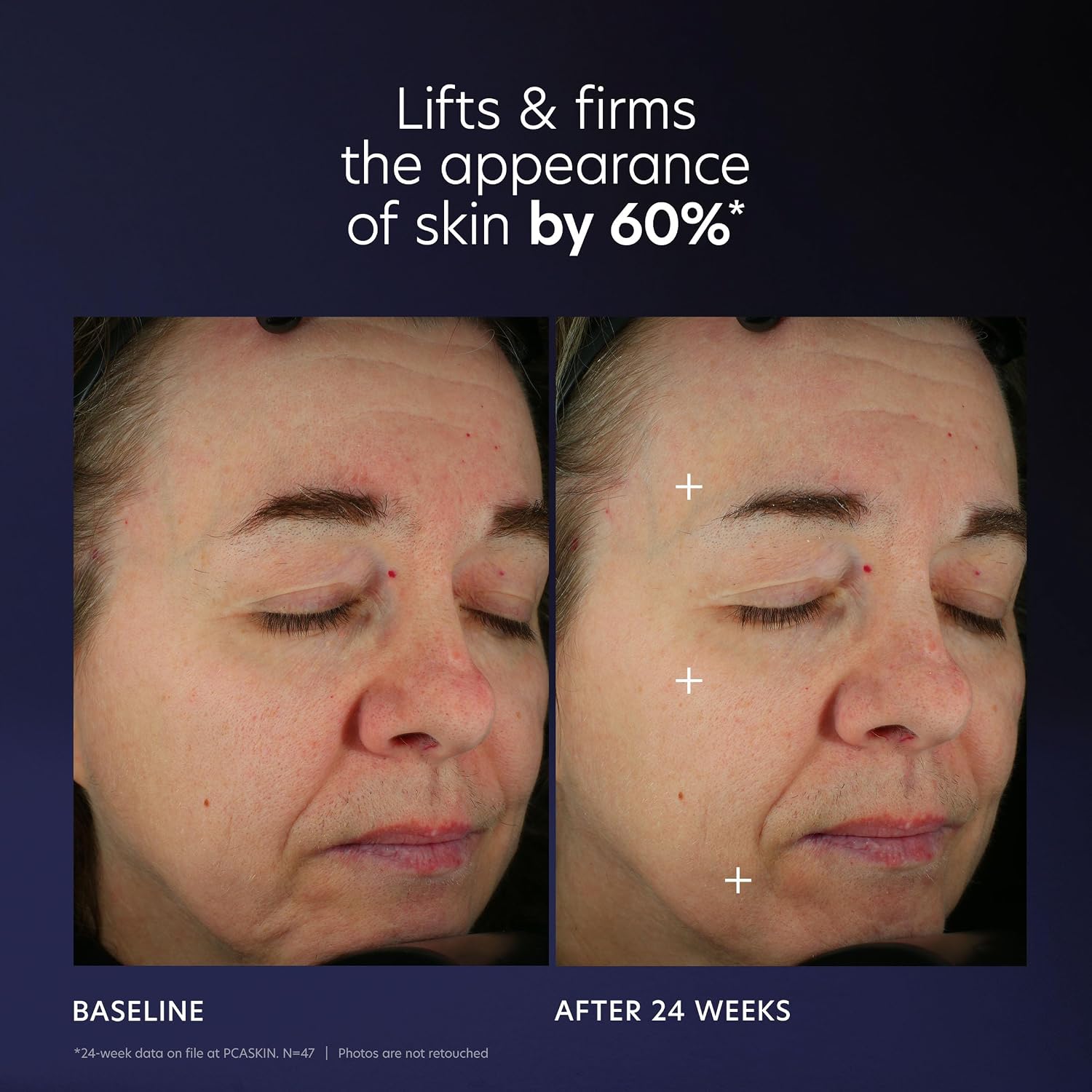 PCA Pro-Max Age Renewal
