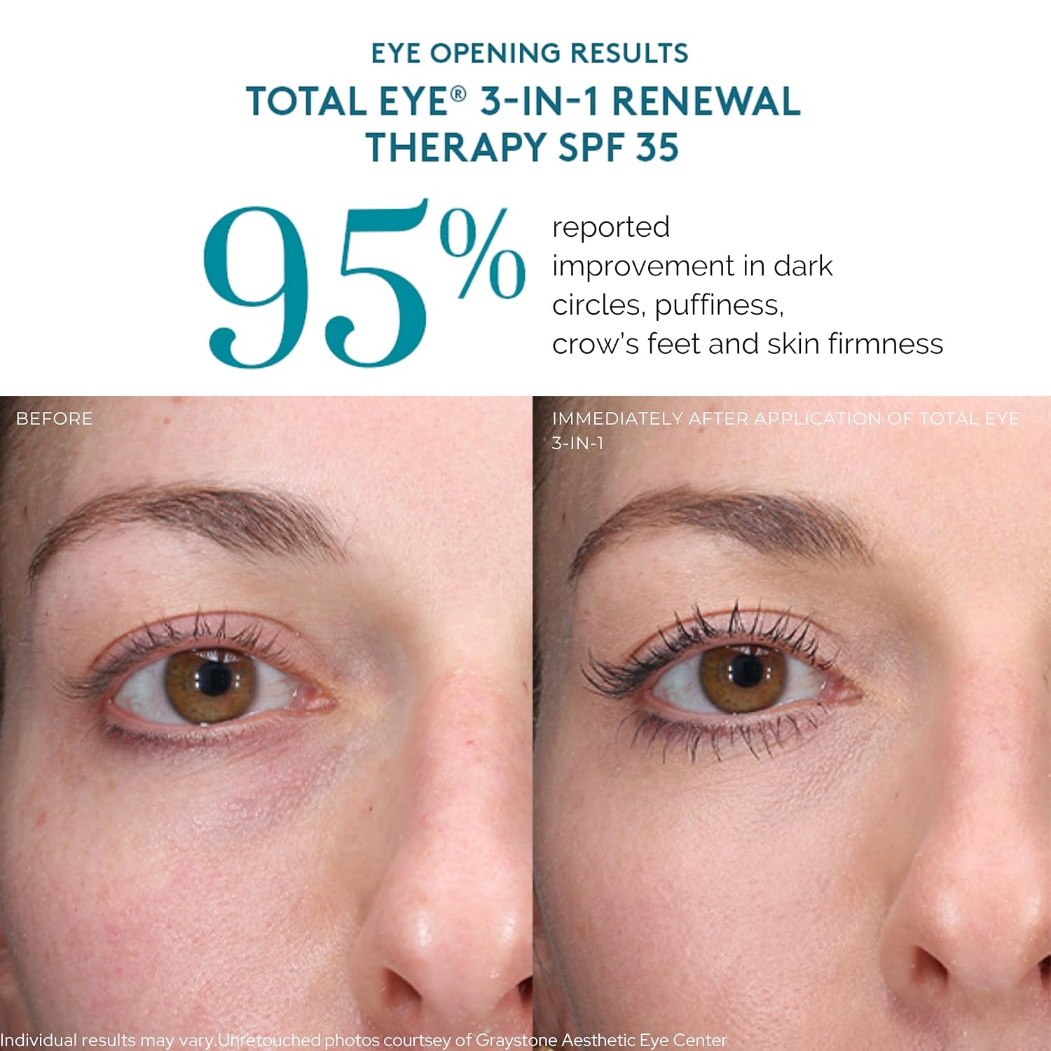 Total Eye SPF 35